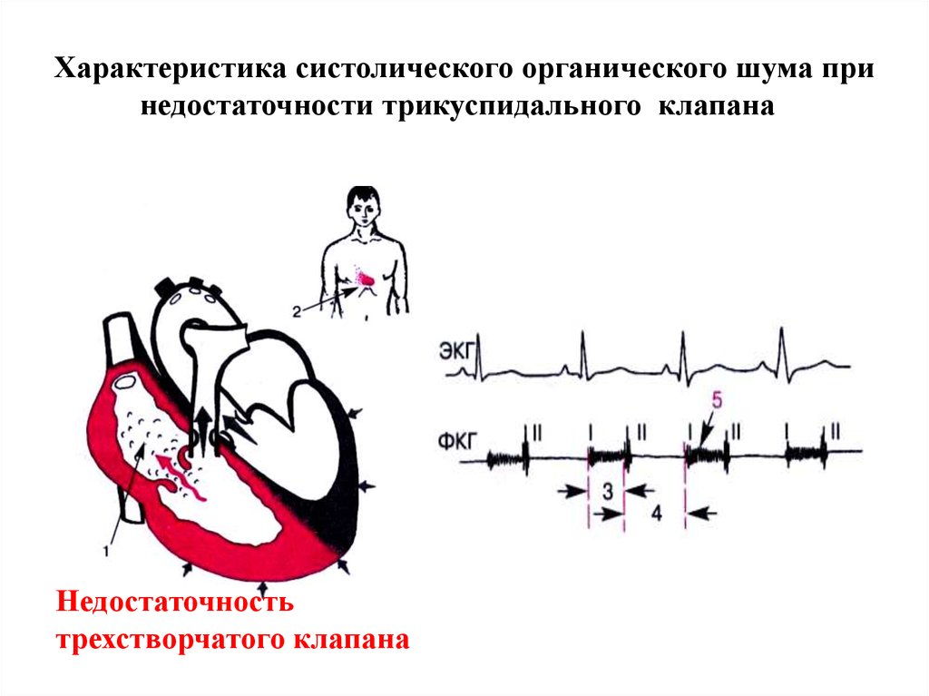 Недостаточность трехстворчатого клапана рисунок