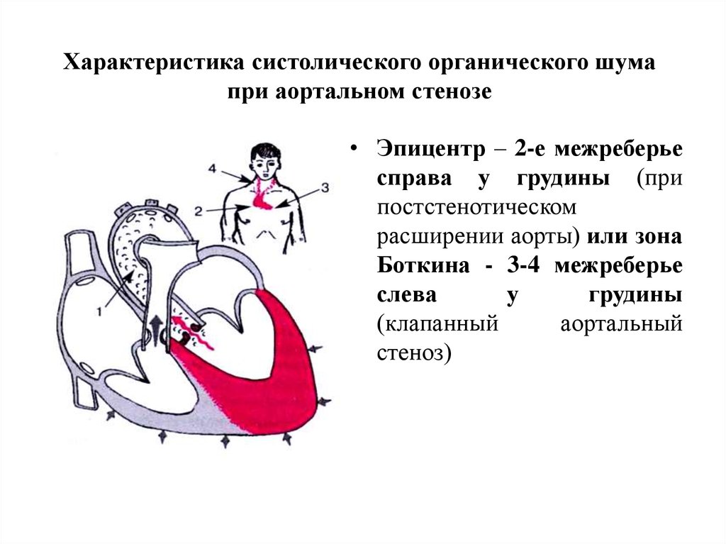 Аускультативная картина при аортальном стенозе характеризуется появлением