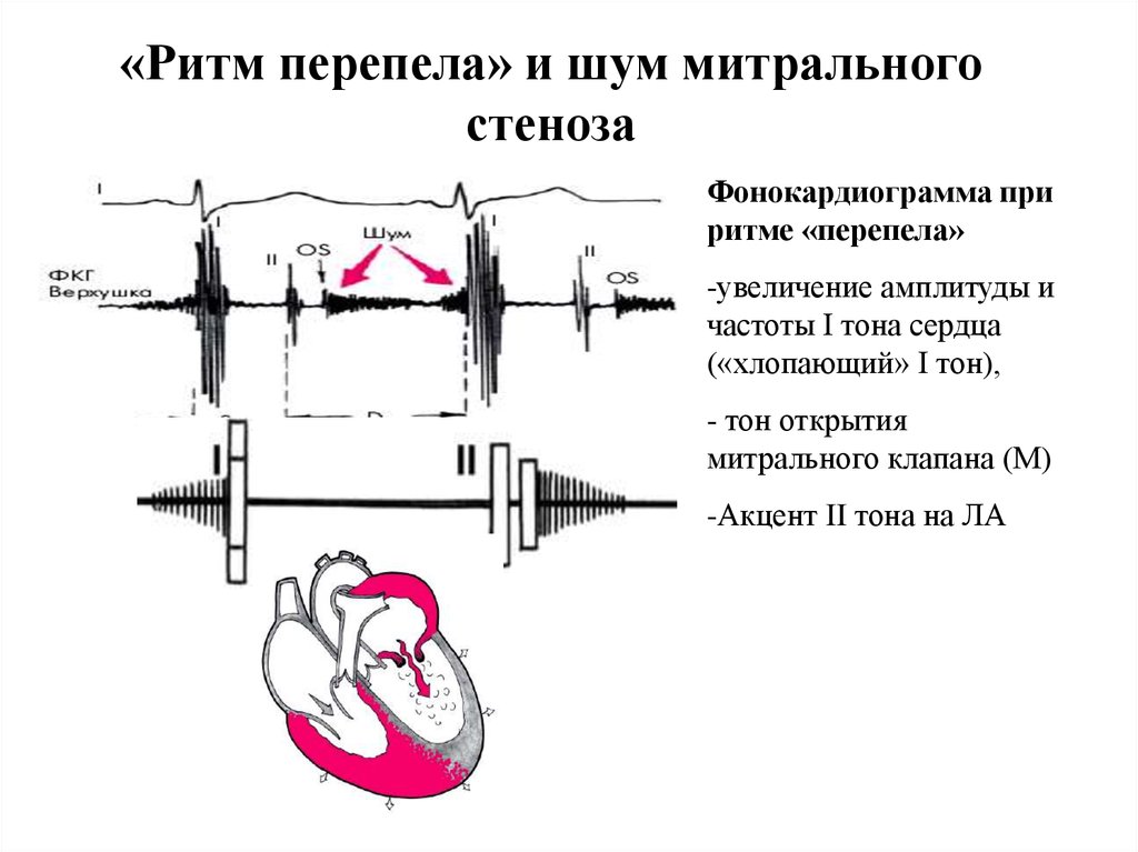 Аускультативная картина i тона сердца при стенозе устья аорты