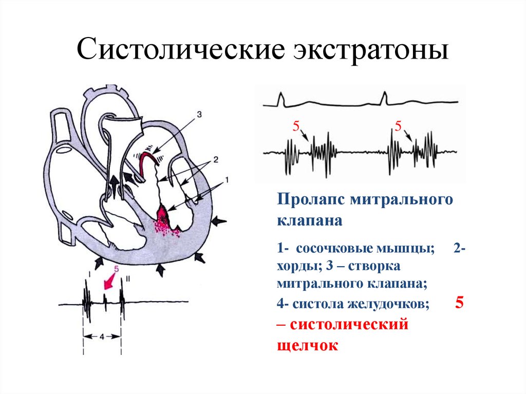 Противофаза клапана. Пролапс передней створки митрального клапана. Пролапс створок митрального клапана. Пролапс митрального клапана 1 степени на ЭКГ. Удлинение хорд митрального клапана на УЗИ сердца.