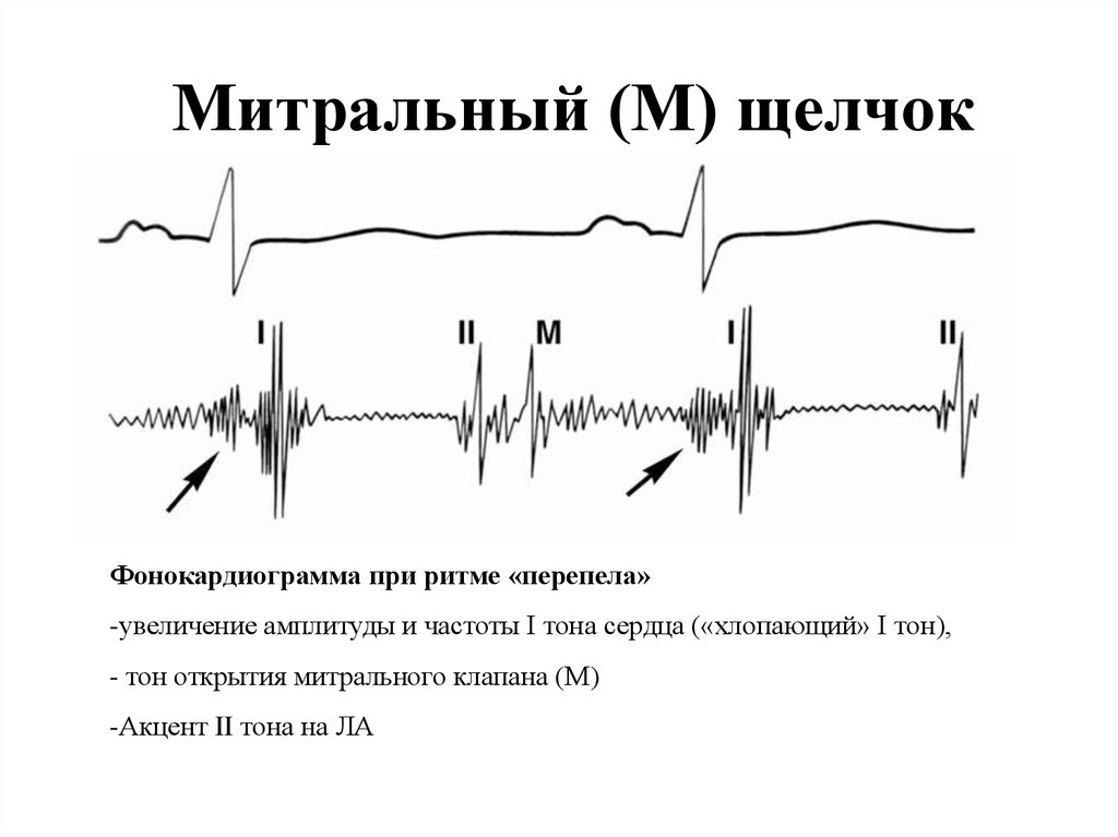 Аускультативная картина митральной недостаточности тест с ответами