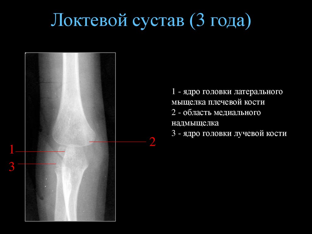 Локтевого мыщелка