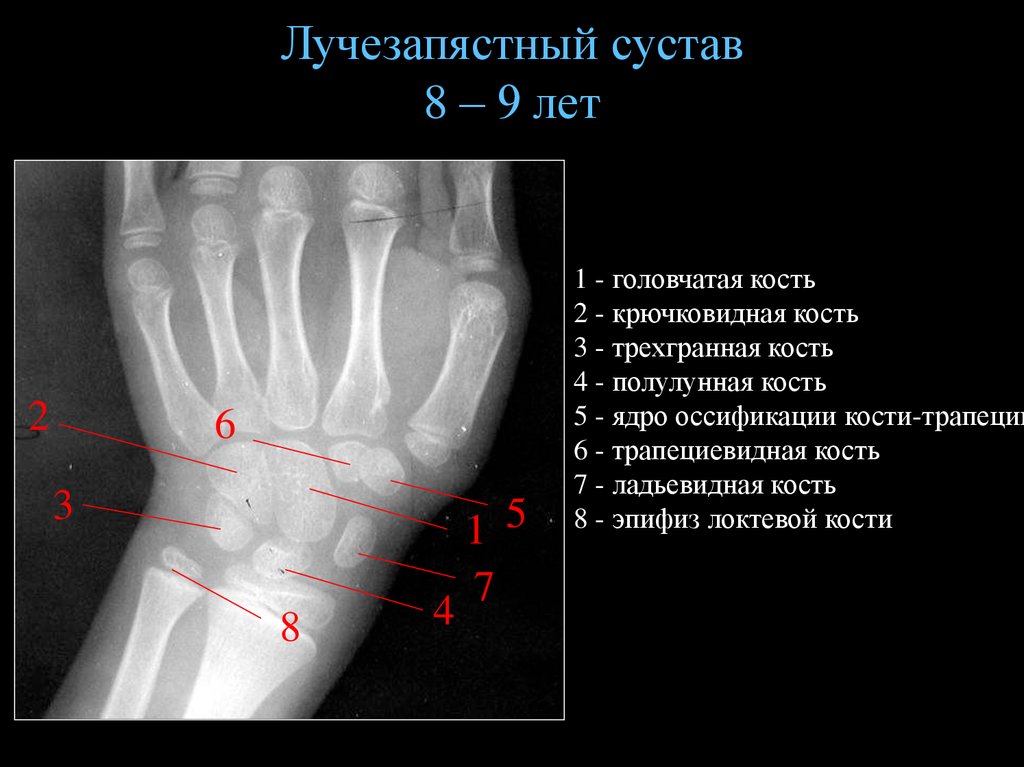 Лучевые кости кисти. Суставы кисти рентген анатомия. Лучезапястный сустав анатомия. Лучезапястный сустав рентген анатомия. Кости лучезапястного сустава анатомия.