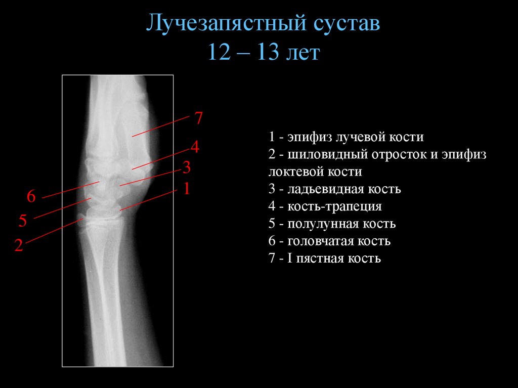 Локтевой отросток локтевой кости. Перелом эпифиза локтевой кости. Дистальный эпифиз локтевой кости на рентгене. Эпифиз лучевой кости. Перелом в области эпифиза локтевой кости.