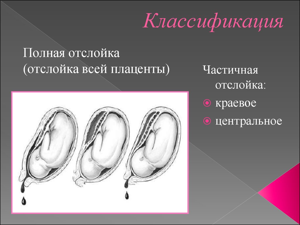 Отслойка нормальной плаценты. Классификация отслойки плаценты. Частичная отслойка плаценты. Преждевременная отслойка плаценты классификация. Полная отслойка плаценты.