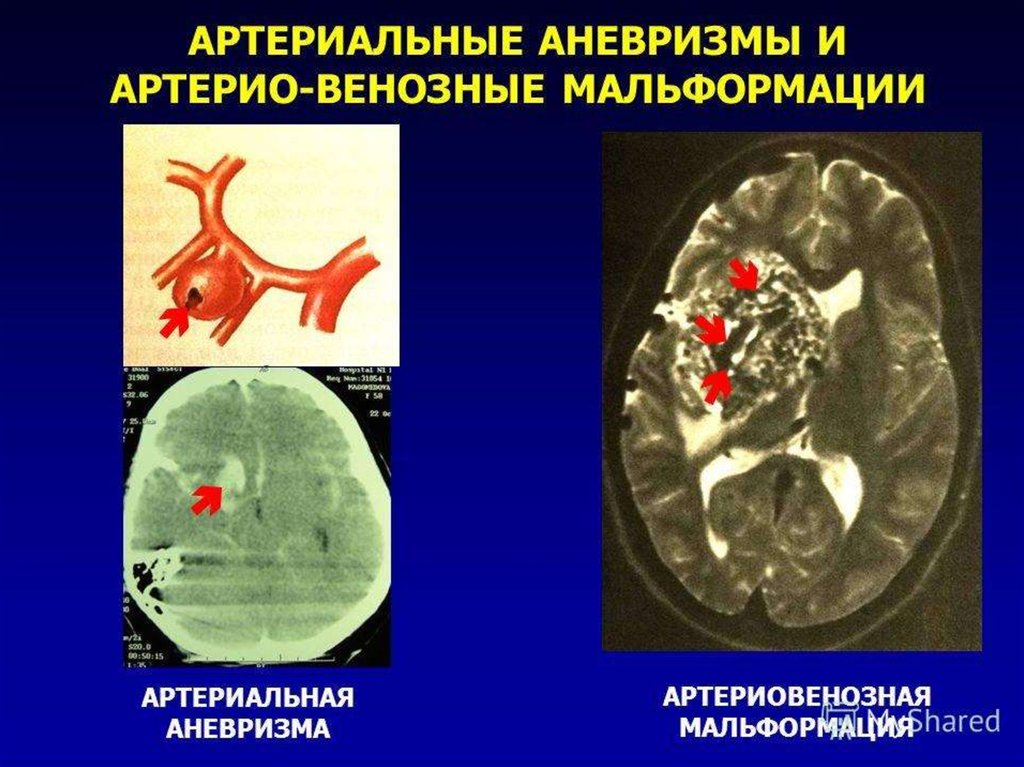 Форум аневризма мозга