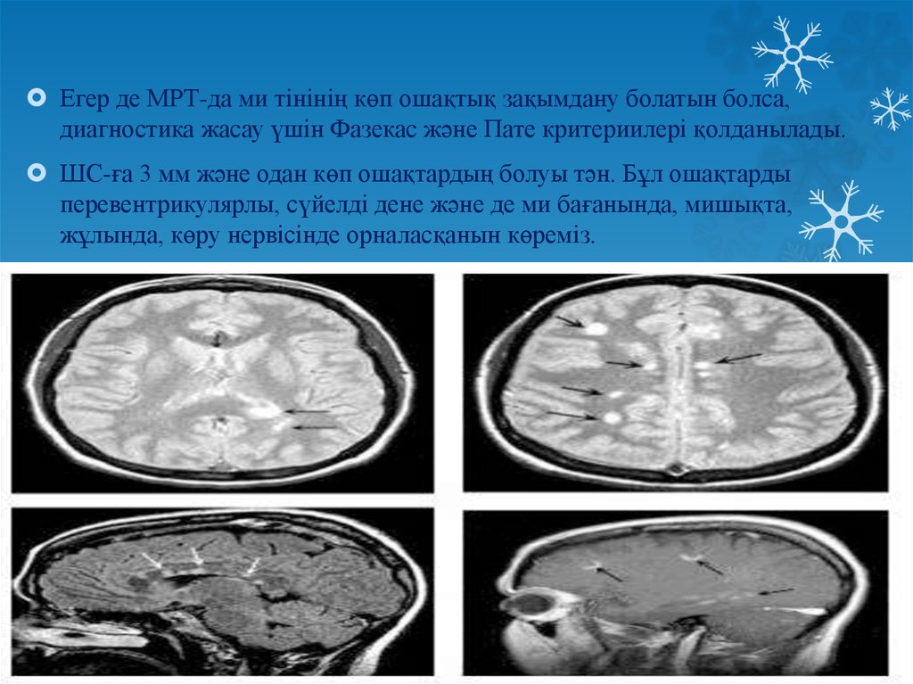 Очаг в головном мозге сосудистого характера. Фазекас мрт. Шкала Фазекас мрт. Очаги Фазекас мрт. Шкала Фазекас и кортикальной атрофии мрт.