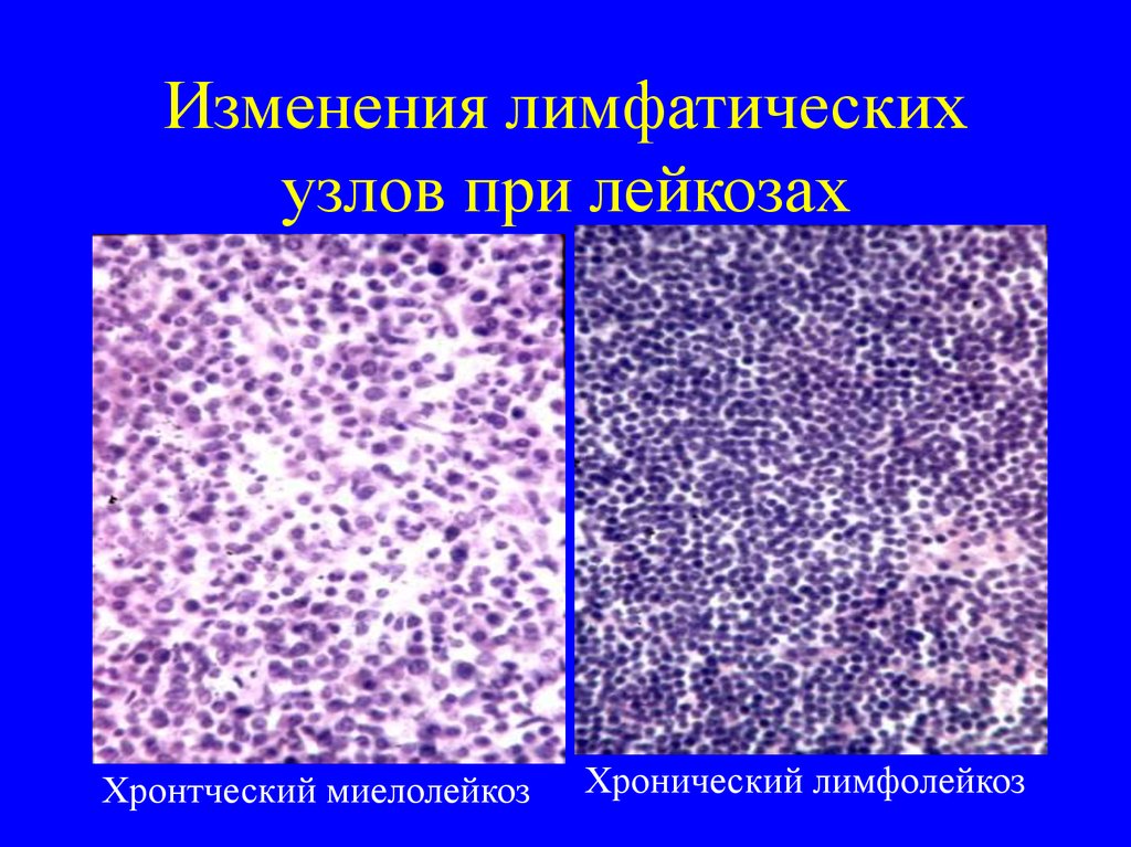 Гиперплазированные лимфоузлы. Лимфатический узел при миелобластном лейкозе микропрепарат. Диффузная лимфома гистология. Лимфатические узлы при хронический лимфолейкоз. Лимфатический узел при остром лейкозе микропрепарат.