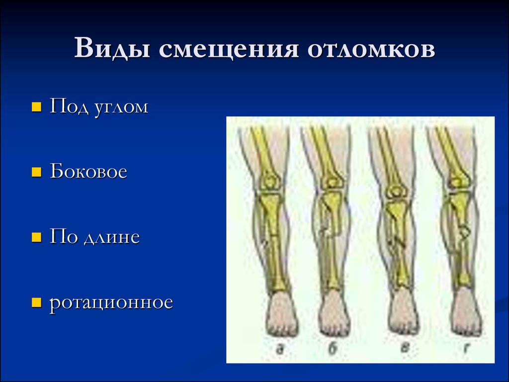 Смещение отломков кости. Классификация смещений костных отломков. Типы смещения костных отломков. Смещение костных отломков по длине. Тип смещения отломков.