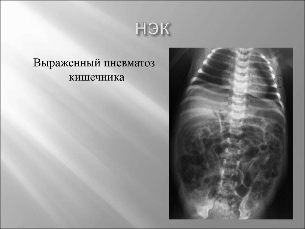 Симптомы пневматоза кишечника лечение. Пневматоз Толстого кишечника рентген. Некротический энтероколит. Выраженный пневматоз кишечника. Пневматизация кишечника рентген.