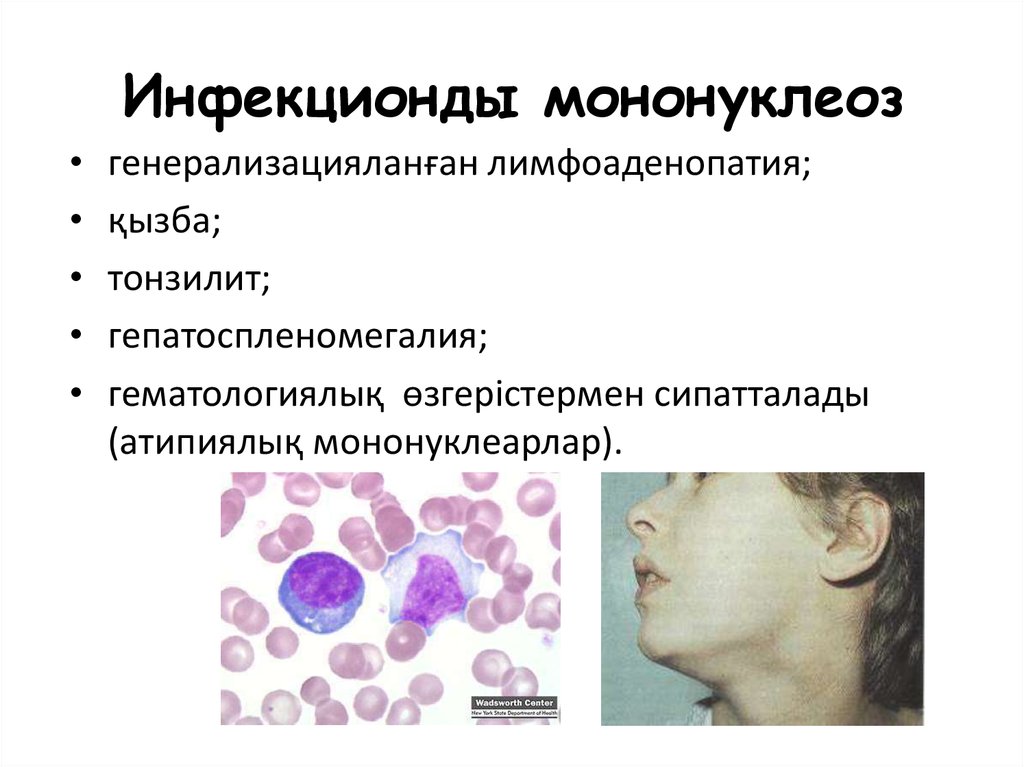 Код инфекционного мононуклеоза. Мононуклеоз.[21. Клинические проявления мононуклеоза. Инфекционный мононуклеоз фарингоскопия. Инфекционный мононуклеоз пятна.