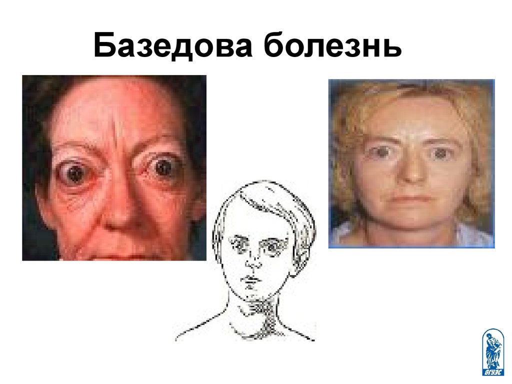 Базедова болезнь