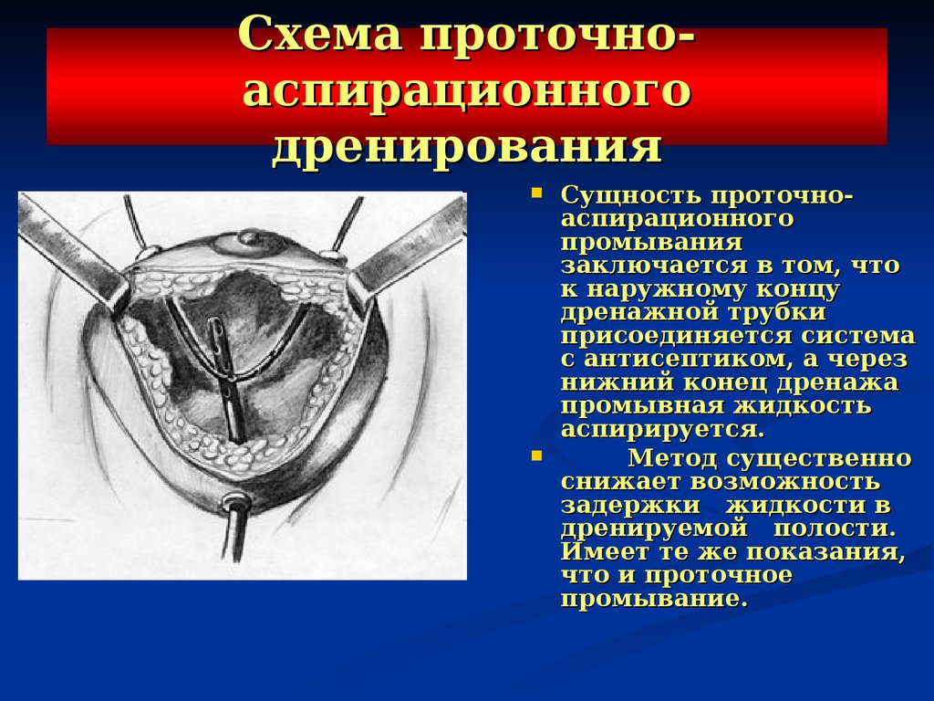 Полость проведение. Аспирационно промывное дренирование полости матки. Проточно промывное дренирование плевральной полости. Аспирационное промывание дренирования матки. Проточно-промывное дренирование раны.