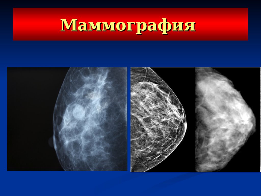 Маммография оренбург. Маммография. Маммография молочных желез. Аналоговая маммография.