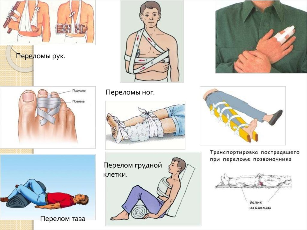 Вывихи и переломы конечностей