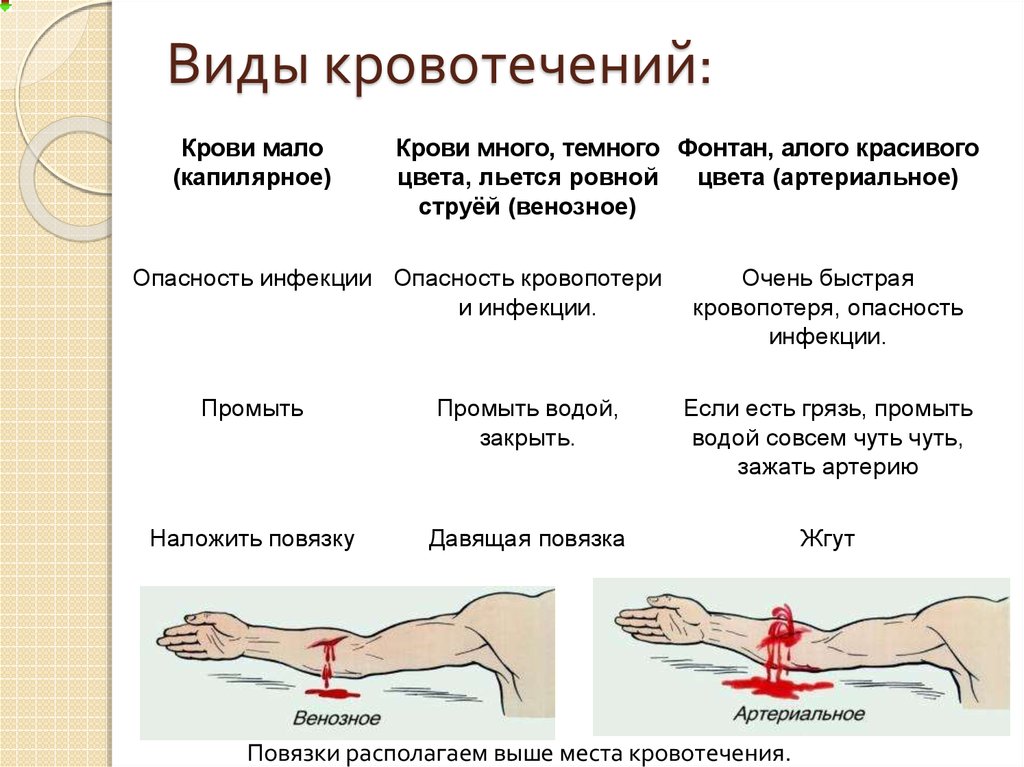 Кровотечение бывают следующих. Типы кровотечений рисунки. Способы остановки крови при разном виде кровотечения. Таблица вид кровотечения краткая характеристика способы остановки. ОБЖ виды кровотечений венозное артериальное.