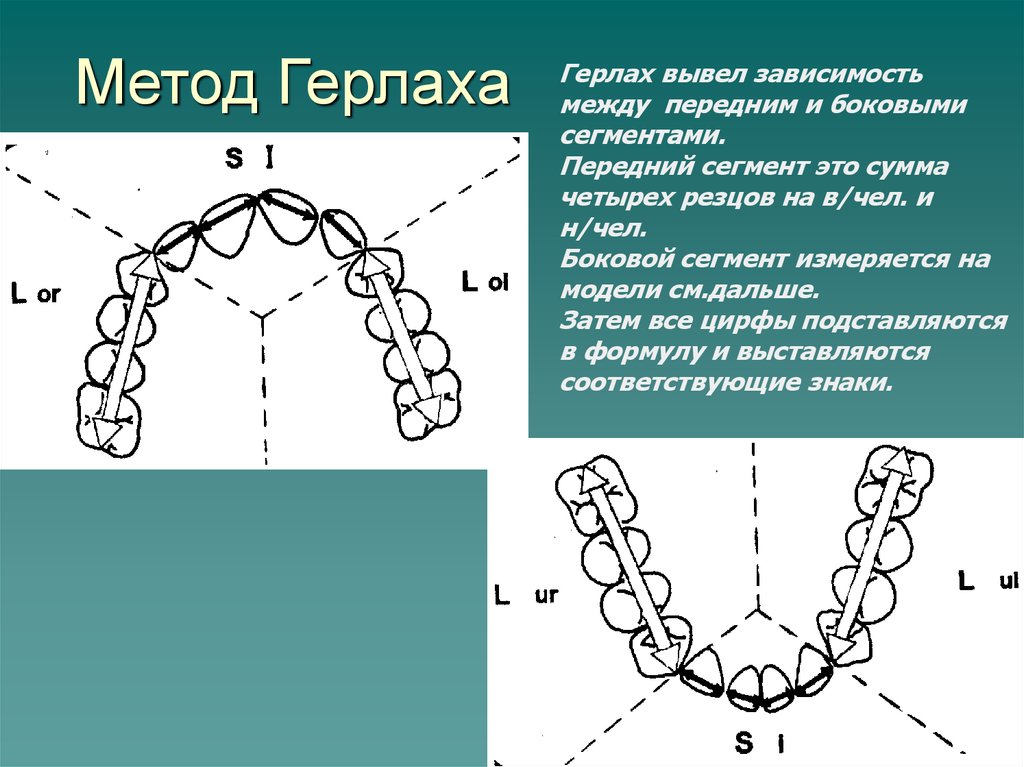 Таблица пона. Метод Герлаха. Метод Герлаха в ортодонтии. Ортодонтия метрд героаза. Методы измерения зубных рядов.