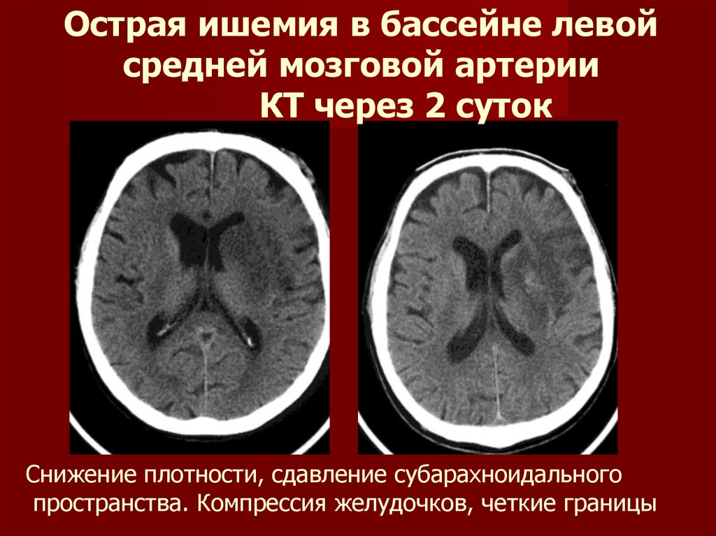 Что такое ишемический инсульт головного мозга. Бассейн левой средней мозговой артерии. Сужение субарахноидального пространства. Ишемический инсульт средней мозговой артерии.
