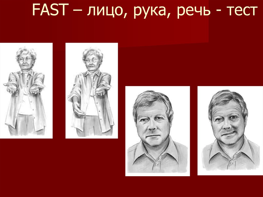 Рука речи. Fast (тест «лицо-рука-речь» ) исследование. Тест лицо рука речь время. Фаст лицо рука речь. Fast тест.