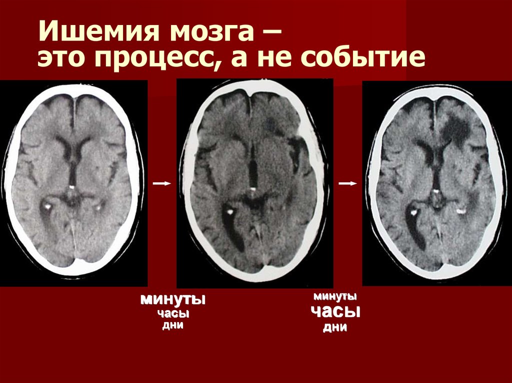 Хроническая ишемия мозга презентация