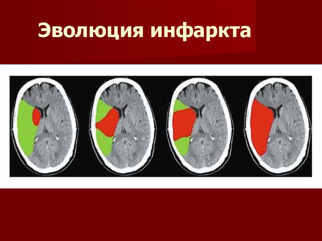 Инсульты и инфаркты презентация