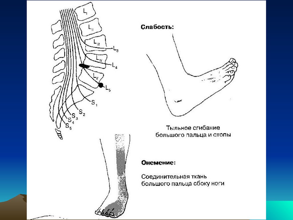 Согнуть стопу. Синдром первого крестцового корешка. Компрессия нервного корешка l4. Корешковый синдром s1. Синдром корешка l4.