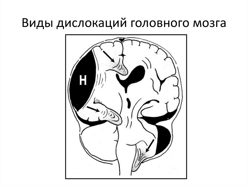 Признаки дислокации