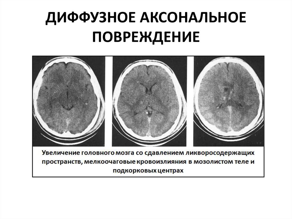 Диффузная атрофия головного. Диффузное аксональное повреждение мрт. Диффузное аксональное повреждение головного мозга кт. Субдуральная гематома на кт. Диффузно аксональные повреждения головного мозга клиника.