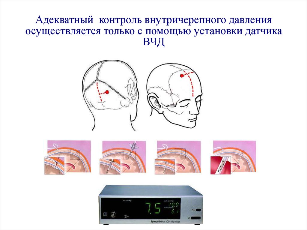 Внутричерепное давление головного мозга. Инвазивный метод измерения внутричерепного давления. Датчик интравентрикулярный для измерения внутричерепного давления. Датчик внутричерепного давления Spiegelberg.