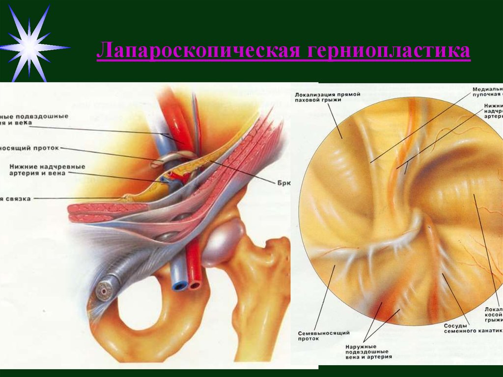 Вентральные грыжи презентация