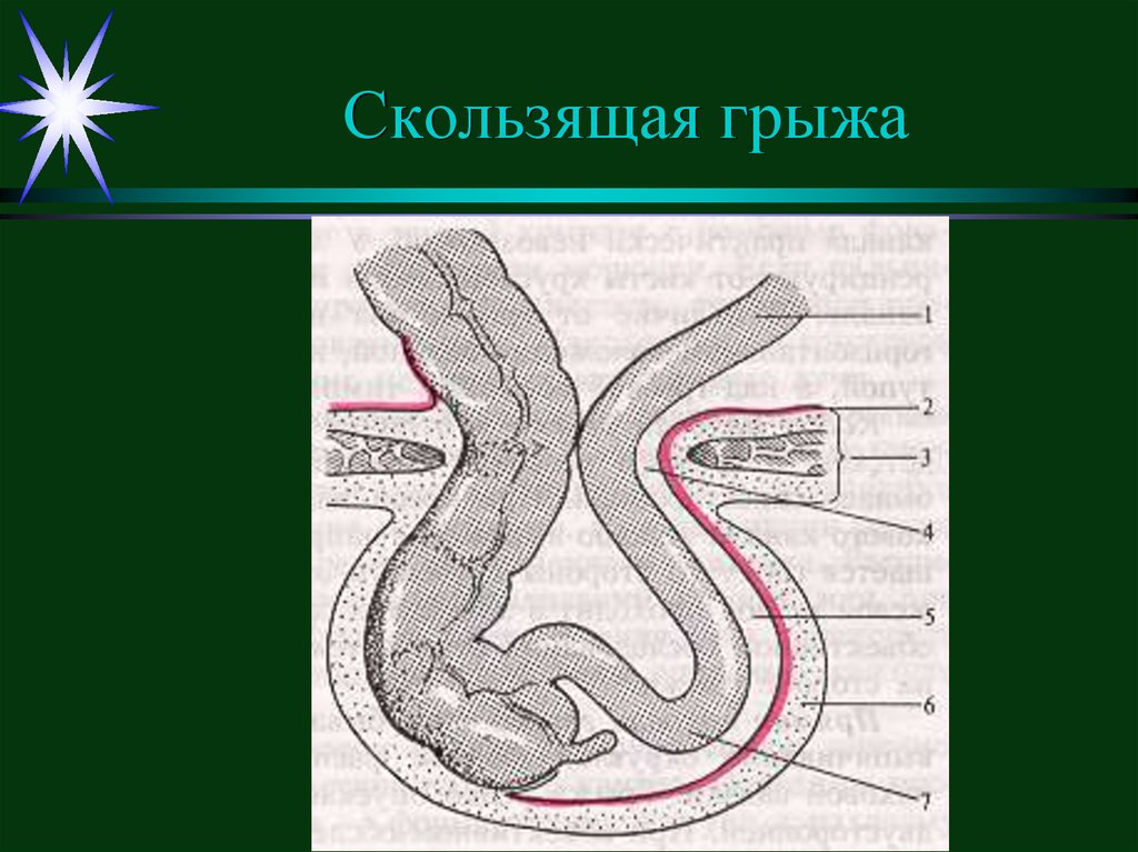 Вентральные грыжи презентация