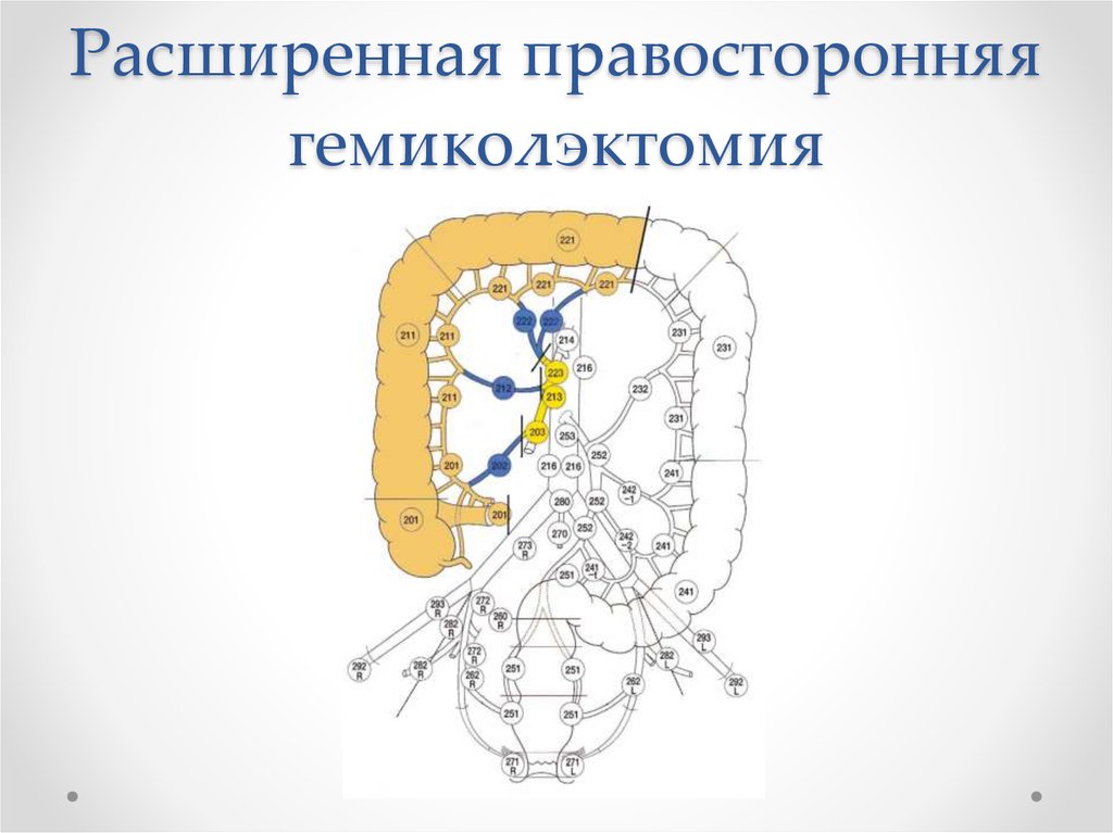 Операция лахея схема