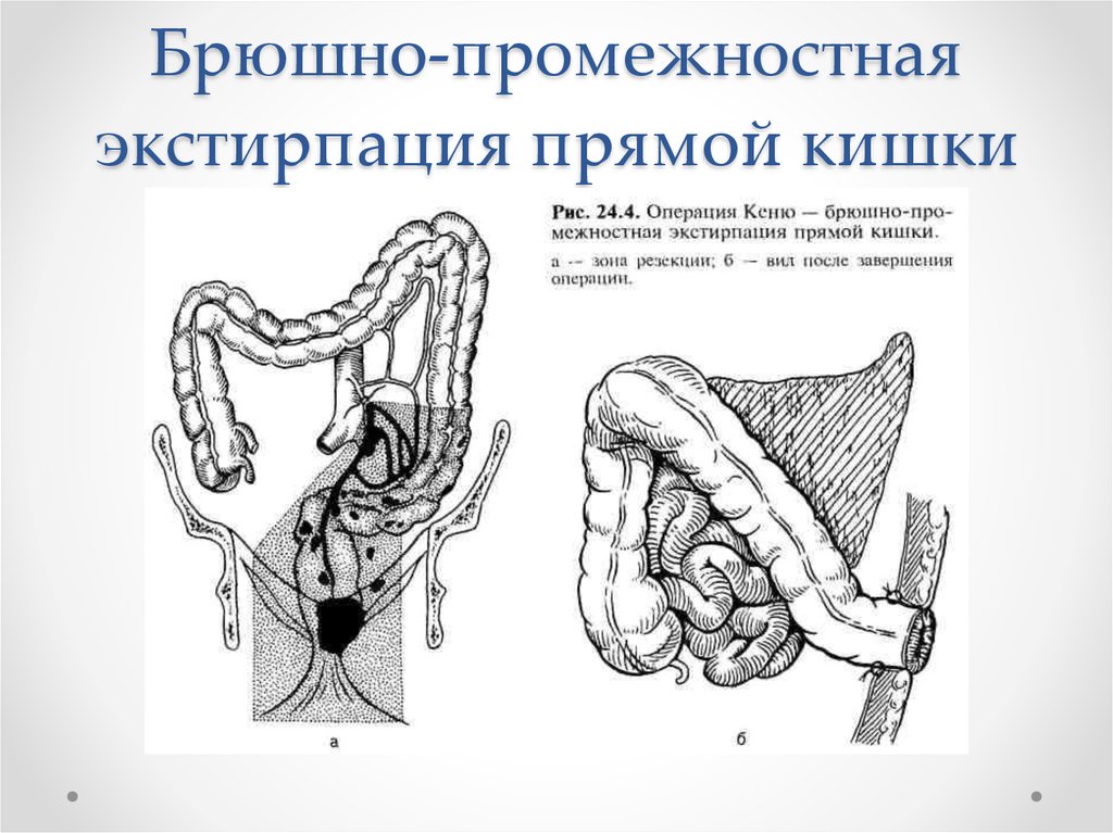 Удаление толстой кишки. Синхронная брюшно-промежностная экстирпация сигмовидной кишки. Брюшноанальную экстирпацию прямой кишки. Брюшно-промежностная экстирпация прямой кишки операция Кеню-Майлса.