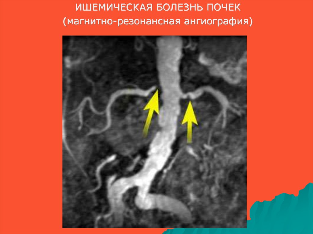 Ишемия почек. Реноваскулярная почечная гипертензия УЗИ. Ишемическая болезнь почек. Ишемическая нефропатия почек. Магнитно-резонансная ангиография почечных артерий.