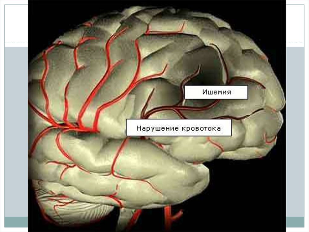 Хроническая ишемия мозга 1. Ишемия мозга. Ишемическая болезнь головного мозга. Недостаточное кровоснабжение головного мозга. Ишемия мозга степени.