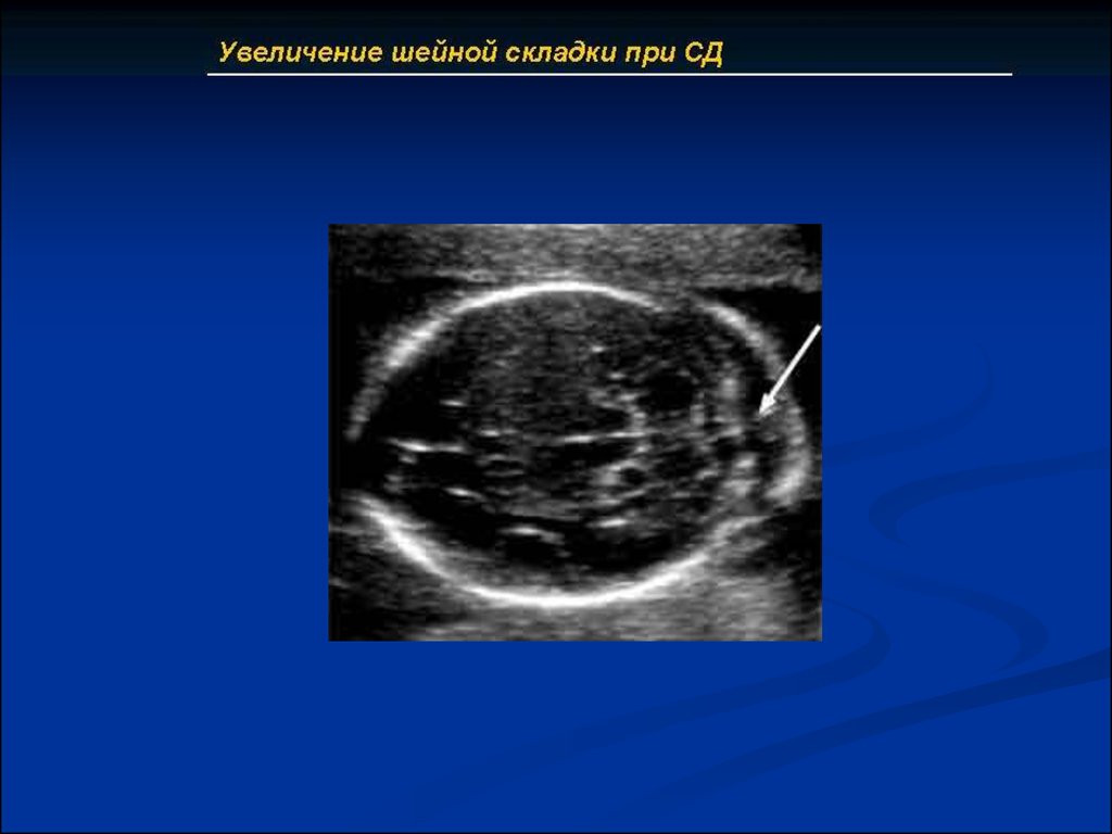 Киста сосудистого сплетения. Ультразвуковые маркеры. Маркеры хромосомной патологии. Утолщение шейной складки.