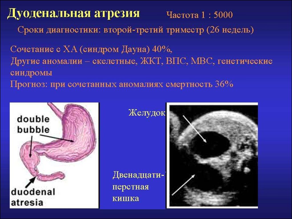 Атрезия это. Атрезия 12 перстной кишки у плода. Атрезия двенадцатиперстной кишки у плода по УЗИ.