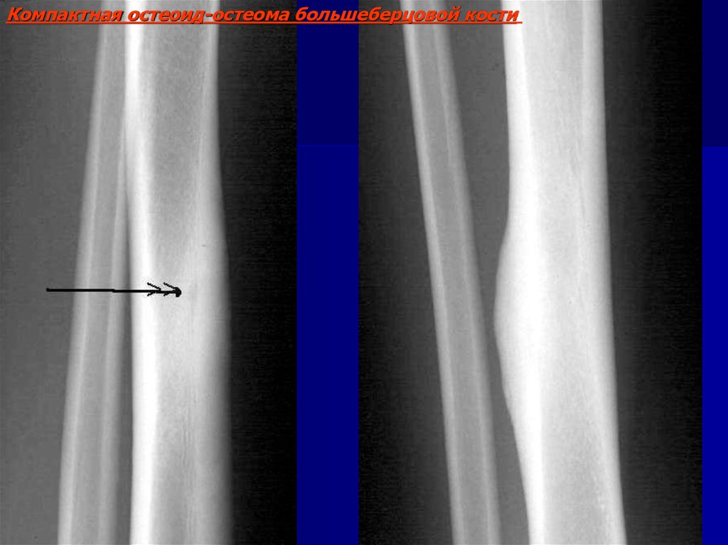 Компактная остеома фото