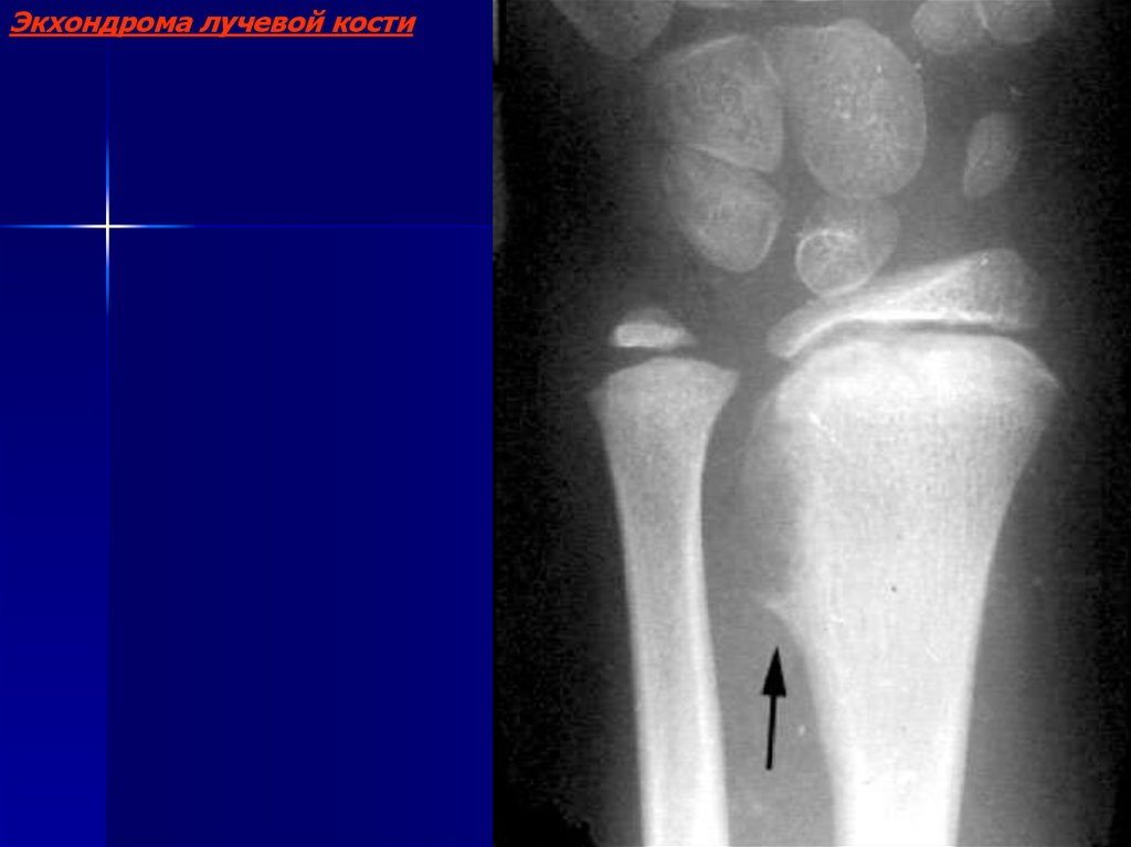 Экхондрома рентгенологическая картина