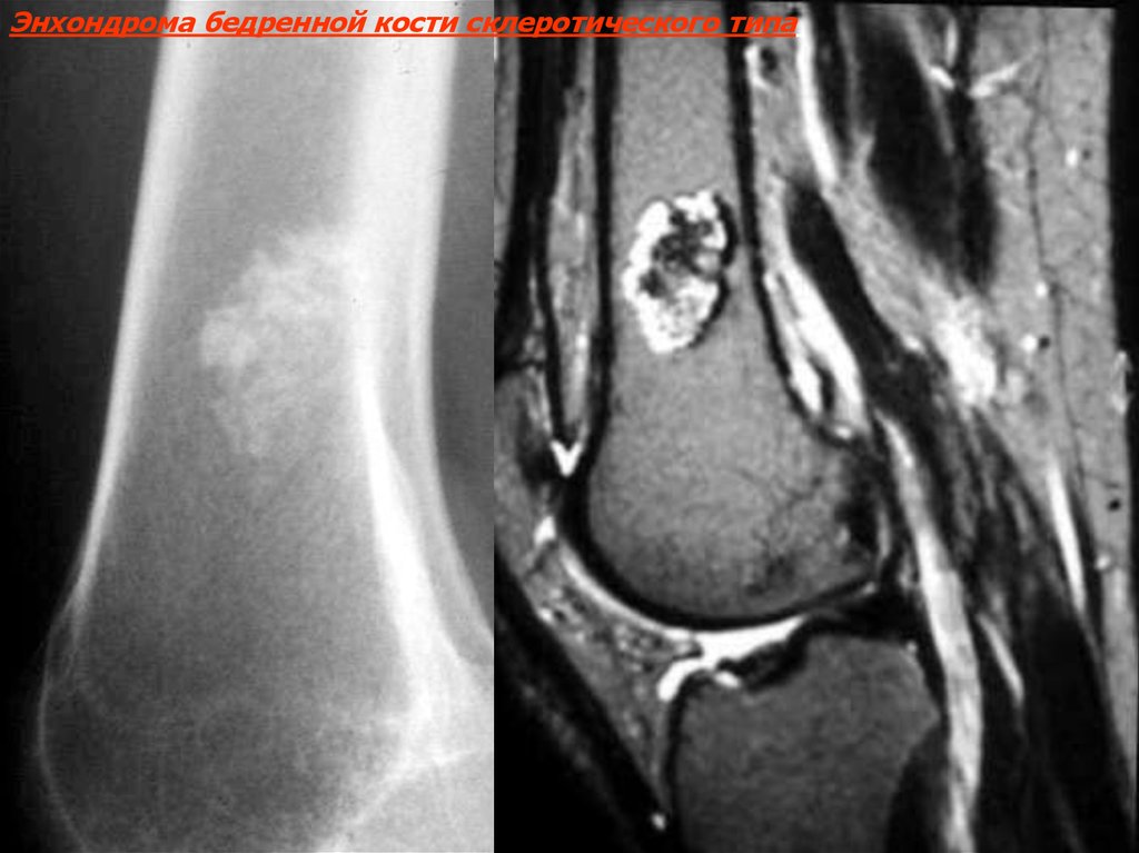 Инфаркт костного мозга коленного. Энхондрома плечевой кости мрт. Энхондрома большеберцовой кости мрт.