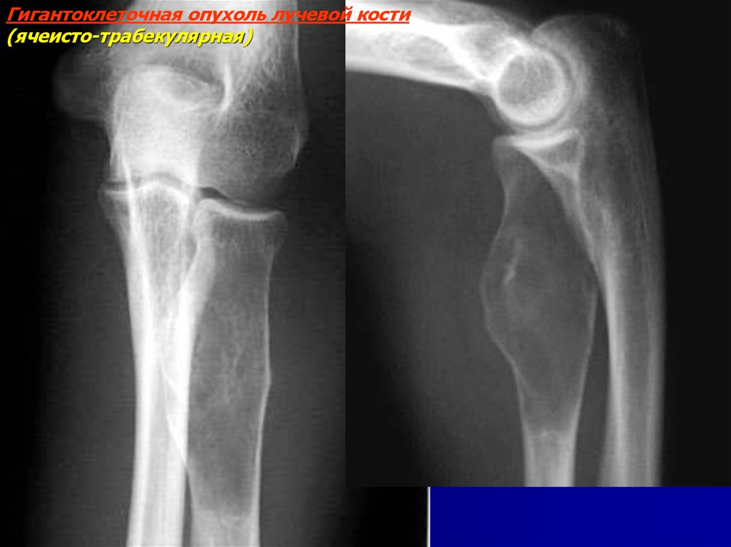 Гигантоклеточная опухоль кости. Доброкачественные опухоли костей. Новообразование в лучевой кости. Доброкачественное новообразование длинных костей нижней конечности.