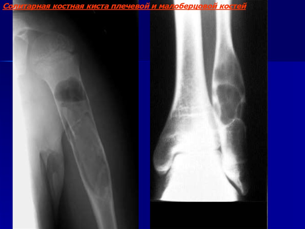 Киста кости. Костная киста малоберцовой кости. Солитарная костная киста малоберцовой кости. Солитарная киста большеберцовой кости рентген. Костная киста плечевой кости рентген.