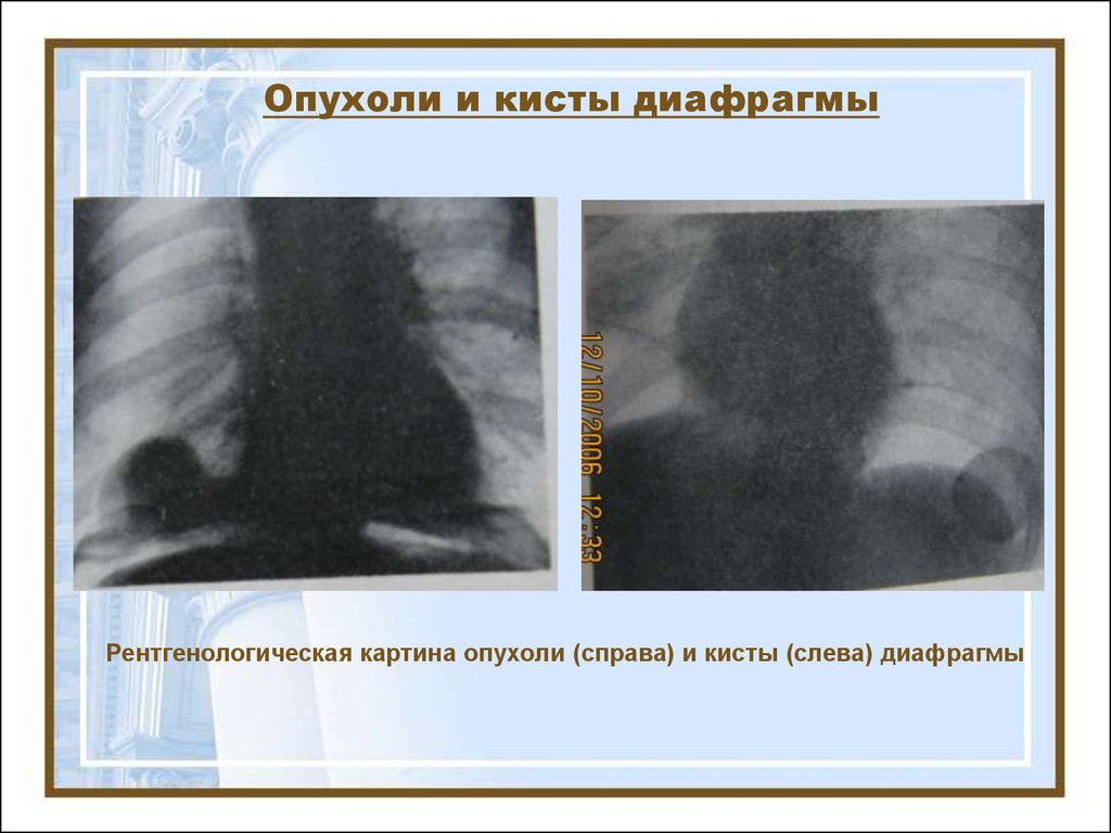 Симптом диафрагмы. Киста диафрагмы рентген. Опухоли диафрагмы рентген. Диафрагмы левый купол киста.