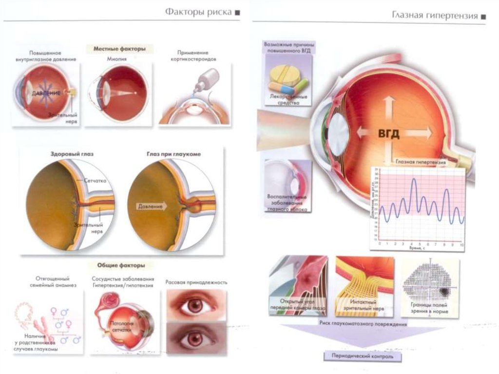Что нельзя делать при глаукоме. Глаукома схема глаза. Внутриглазное давление глаукома.