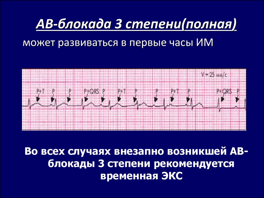 Ав блокада это