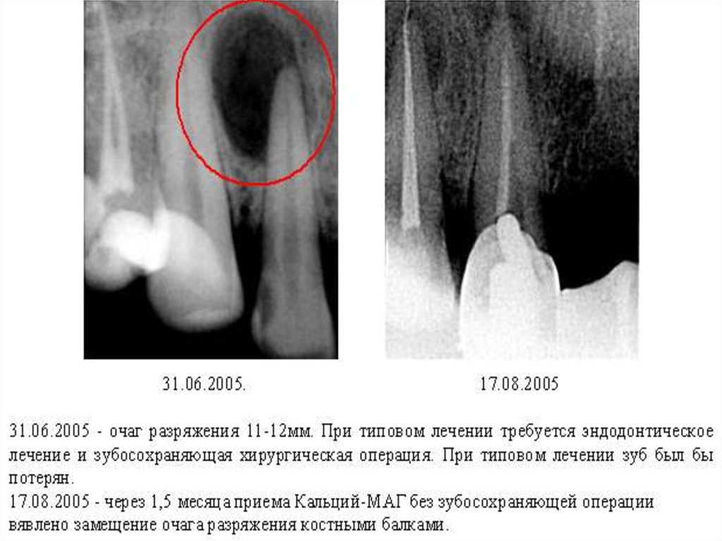 Разряжение костной ткани. Одонтогенная радикулярная киста. Разряжение костной ткани нижней челюсти. Рентгенограмма зуба очаг разряжения 5 мм. Одонтогенная киста на рентгенограмме.