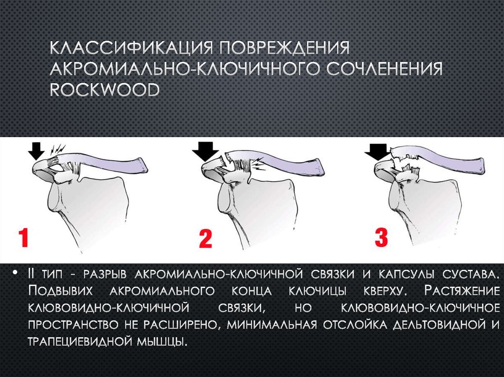 Классификация повреждения акромиально-ключичного сочленения Rockwood