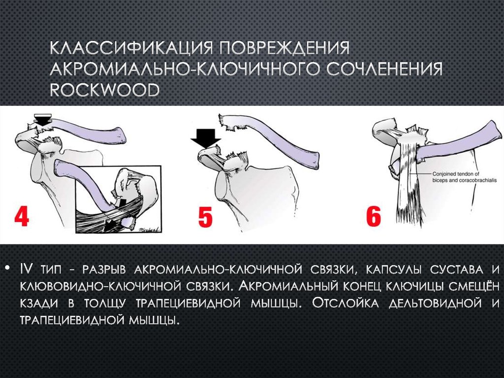 Классификация повреждения акромиально-ключичного сочленения Rockwood