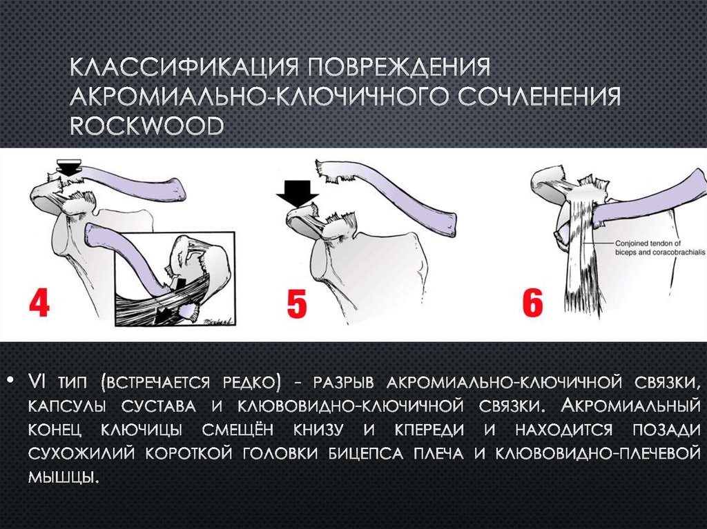 Классификация повреждения акромиально-ключичного сочленения Rockwood