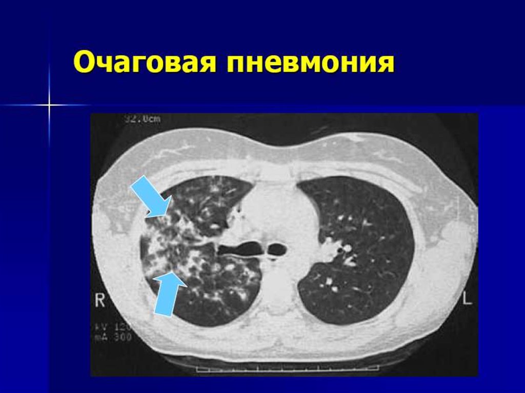 Кт при пневмонии. Очаговая бактериальная пневмония кт. Очагово сливная пневмония на кт. Очаговая бронхопневмония кт. Очаговая пневмония кт.